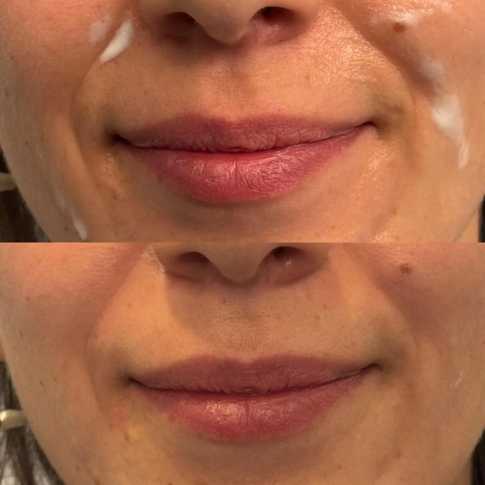 Nasolabial Fold Filler - Before & After